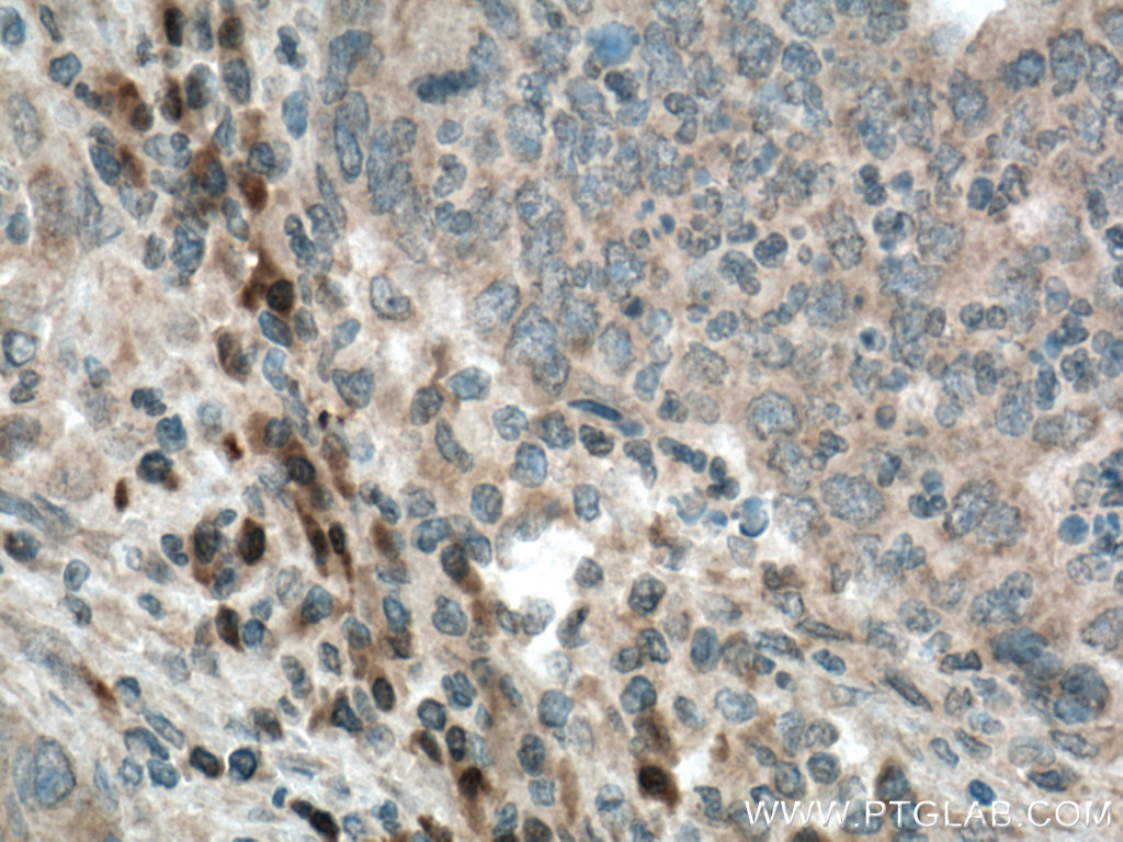 Immunohistochemistry (IHC) staining of human colon cancer tissue using USP49 Polyclonal antibody (18066-1-AP)