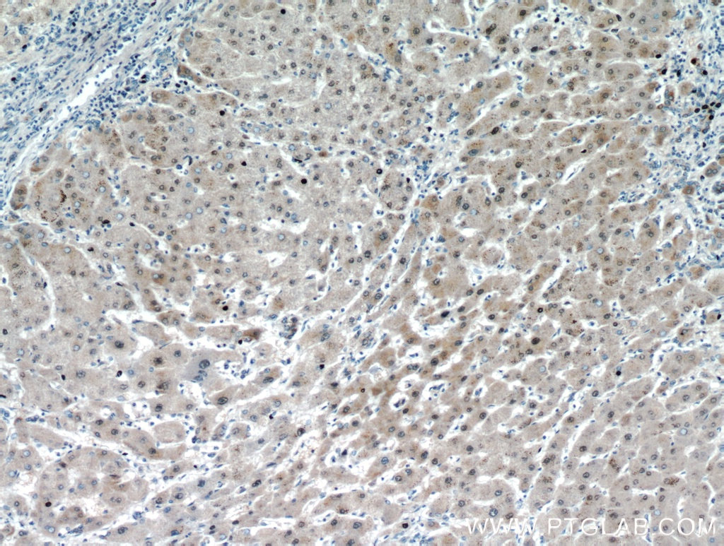 Immunohistochemistry (IHC) staining of human hepatocirrhosis tissue using USP50 Polyclonal antibody (20374-1-AP)