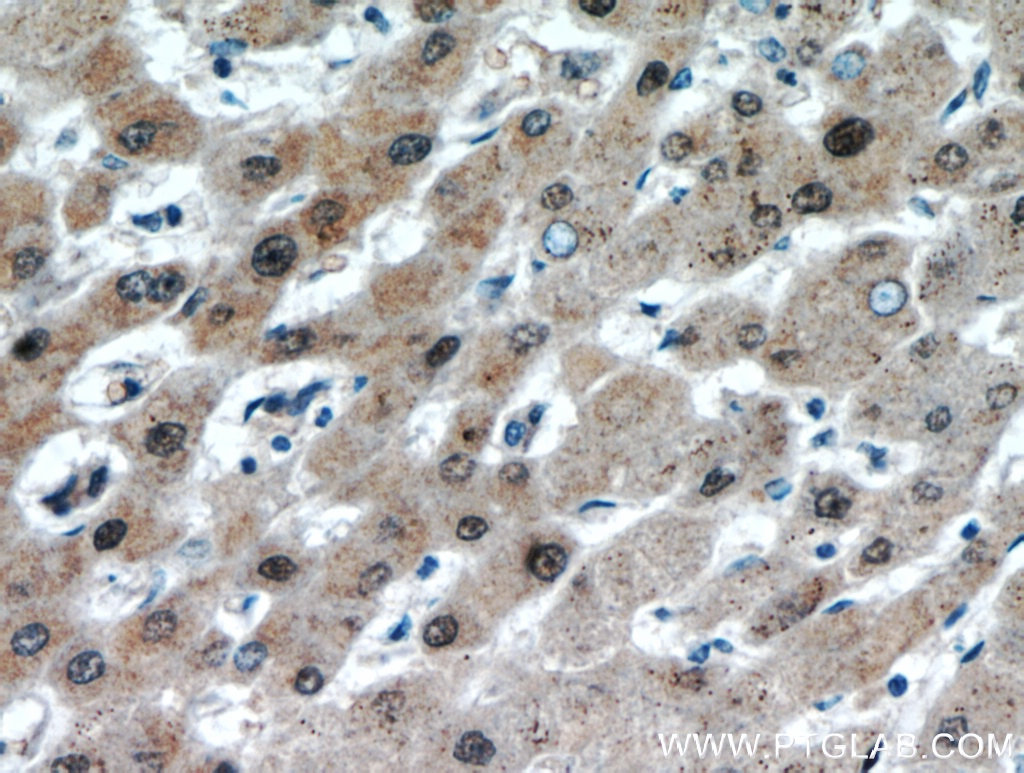 Immunohistochemistry (IHC) staining of human hepatocirrhosis tissue using USP50 Polyclonal antibody (20374-1-AP)