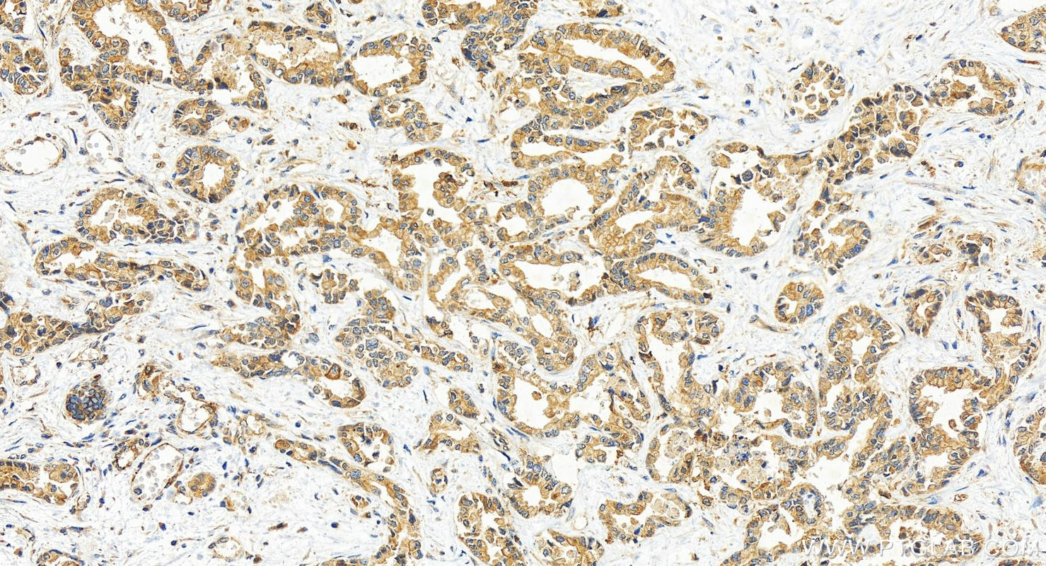 Immunohistochemistry (IHC) staining of human intrahepatic cholangiocarcinoma tissue using USP6NL Polyclonal antibody (30440-1-AP)