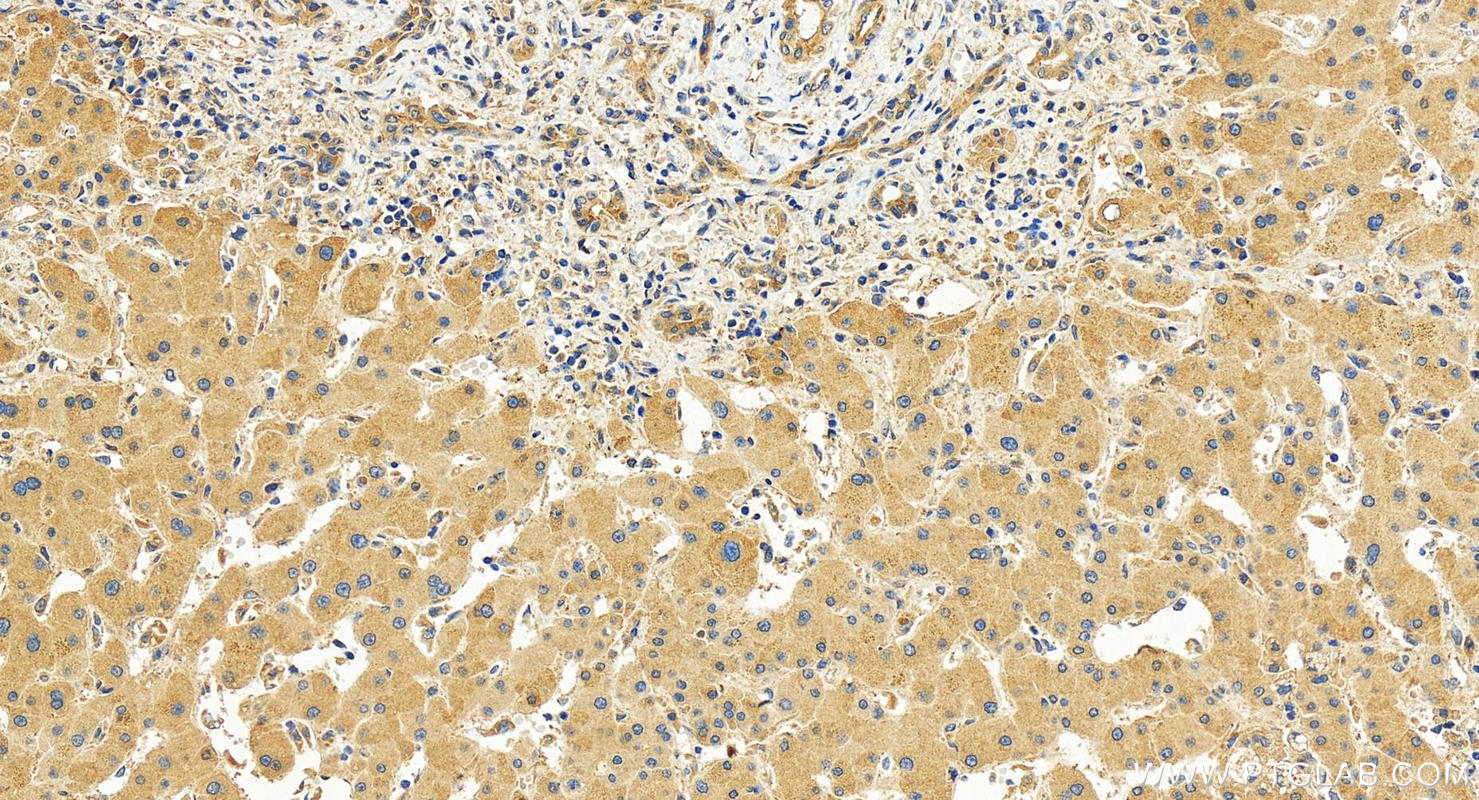 Immunohistochemistry (IHC) staining of human intrahepatic cholangiocarcinoma tissue using USP6NL Polyclonal antibody (30440-1-AP)