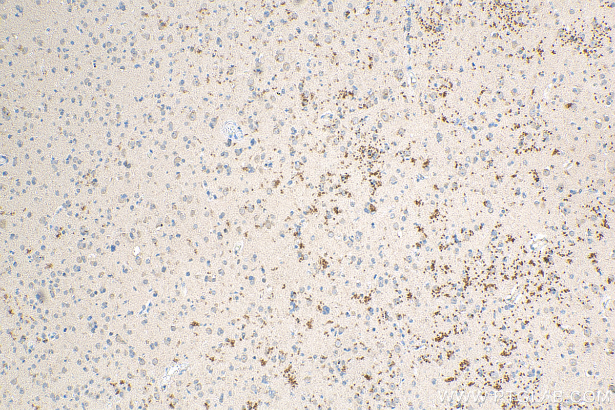 Immunohistochemistry (IHC) staining of human gliomas tissue using Ubiquilin 1 Polyclonal antibody (23516-1-AP)