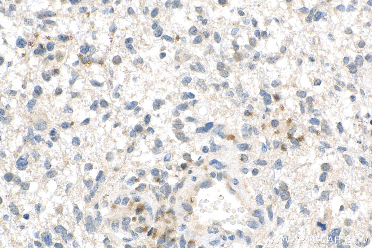 Immunohistochemistry (IHC) staining of human gliomas tissue using Ubiquilin 1 Polyclonal antibody (23516-1-AP)