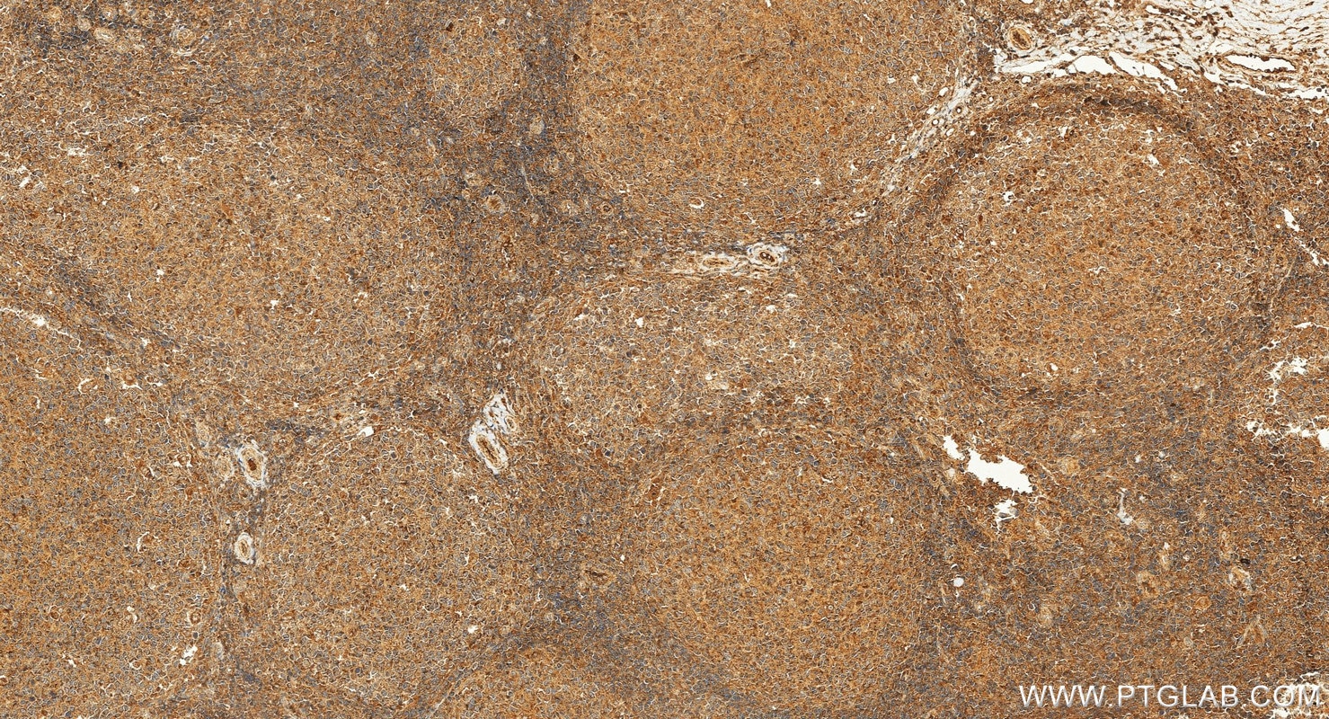 Immunohistochemistry (IHC) staining of human tonsillitis tissue using VAV1 Polyclonal antibody (16364-1-AP)