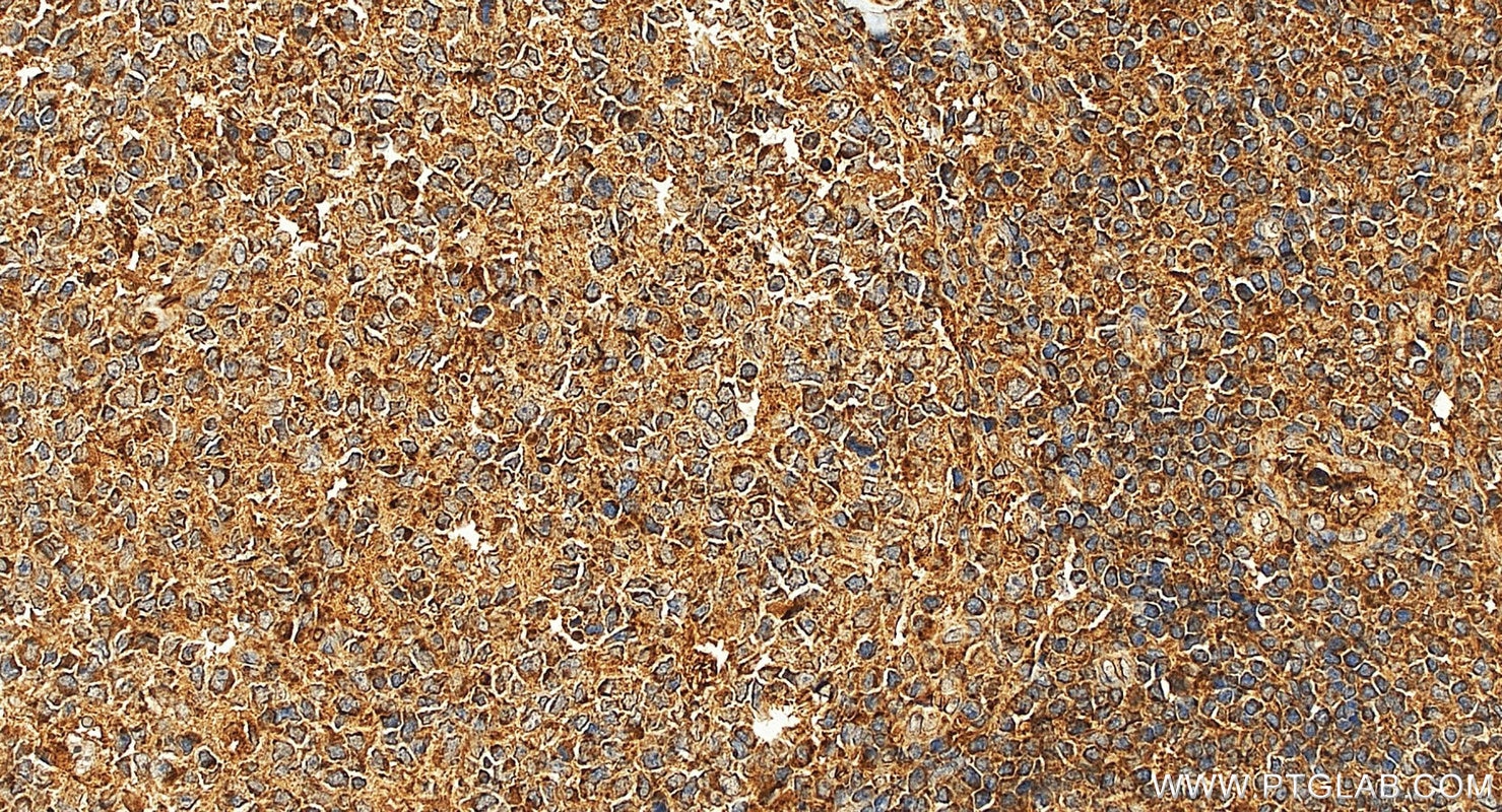 Immunohistochemistry (IHC) staining of human tonsillitis tissue using VAV1 Polyclonal antibody (16364-1-AP)