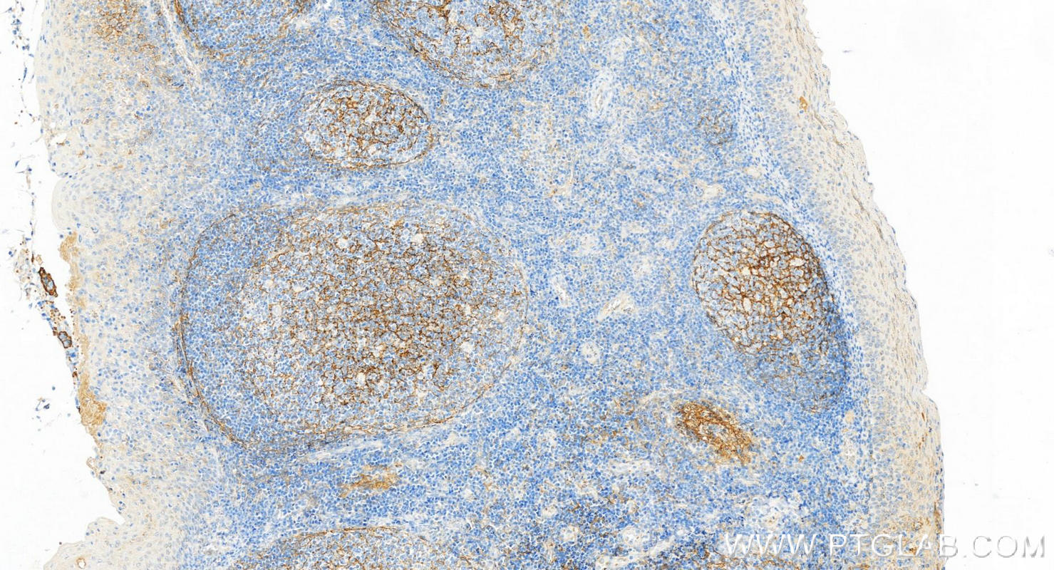 Immunohistochemistry (IHC) staining of human tonsillitis tissue using VCAM-1/CD106 Monoclonal antibody (66294-1-Ig)