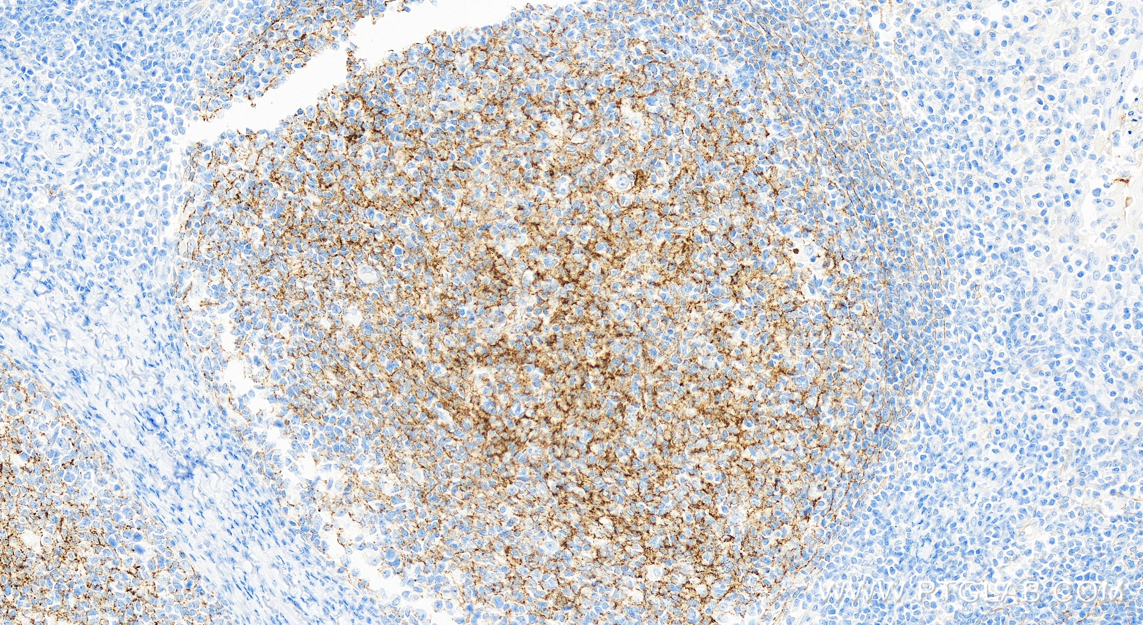 Immunohistochemistry (IHC) staining of human tonsillitis tissue using VCAM-1/CD106 Recombinant antibody (84249-4-RR)