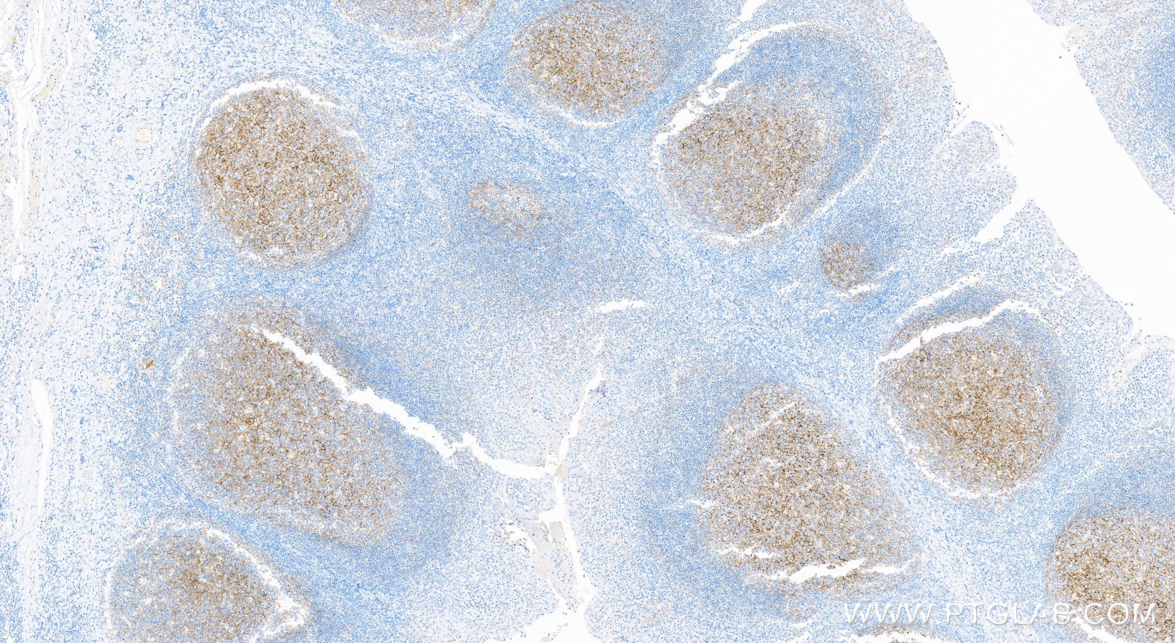 Immunohistochemistry (IHC) staining of human tonsillitis tissue using VCAM-1/CD106 Recombinant antibody (84249-4-RR)