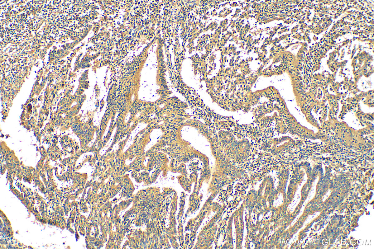 Immunohistochemistry (IHC) staining of human endometrial cancer tissue using VCAN Polyclonal antibody (30599-1-AP)