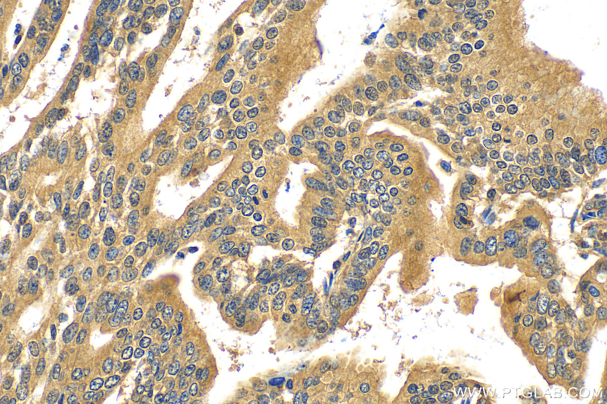 Immunohistochemistry (IHC) staining of human endometrial cancer tissue using VCAN Polyclonal antibody (30599-1-AP)