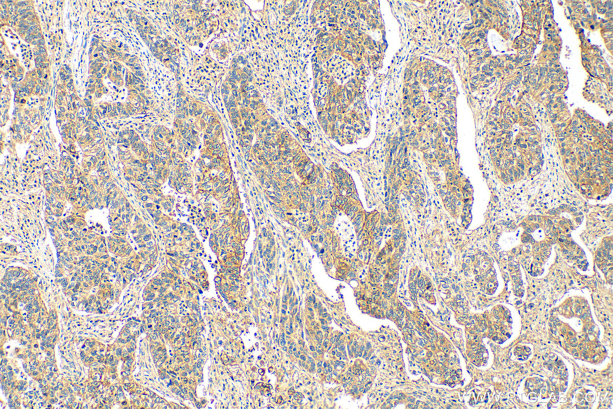 Immunohistochemistry (IHC) staining of human stomach cancer tissue using VCAN Polyclonal antibody (30599-1-AP)