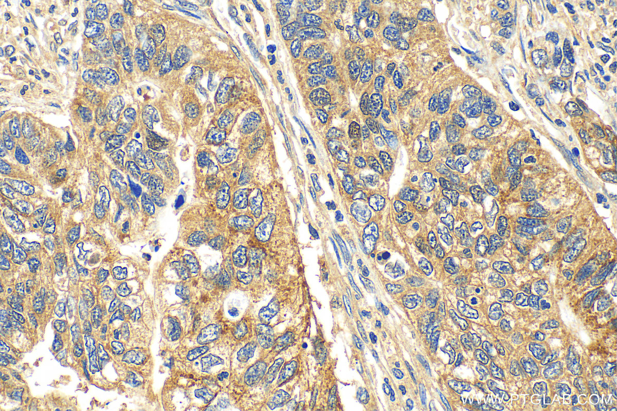 Immunohistochemistry (IHC) staining of human stomach cancer tissue using VCAN Polyclonal antibody (30599-1-AP)