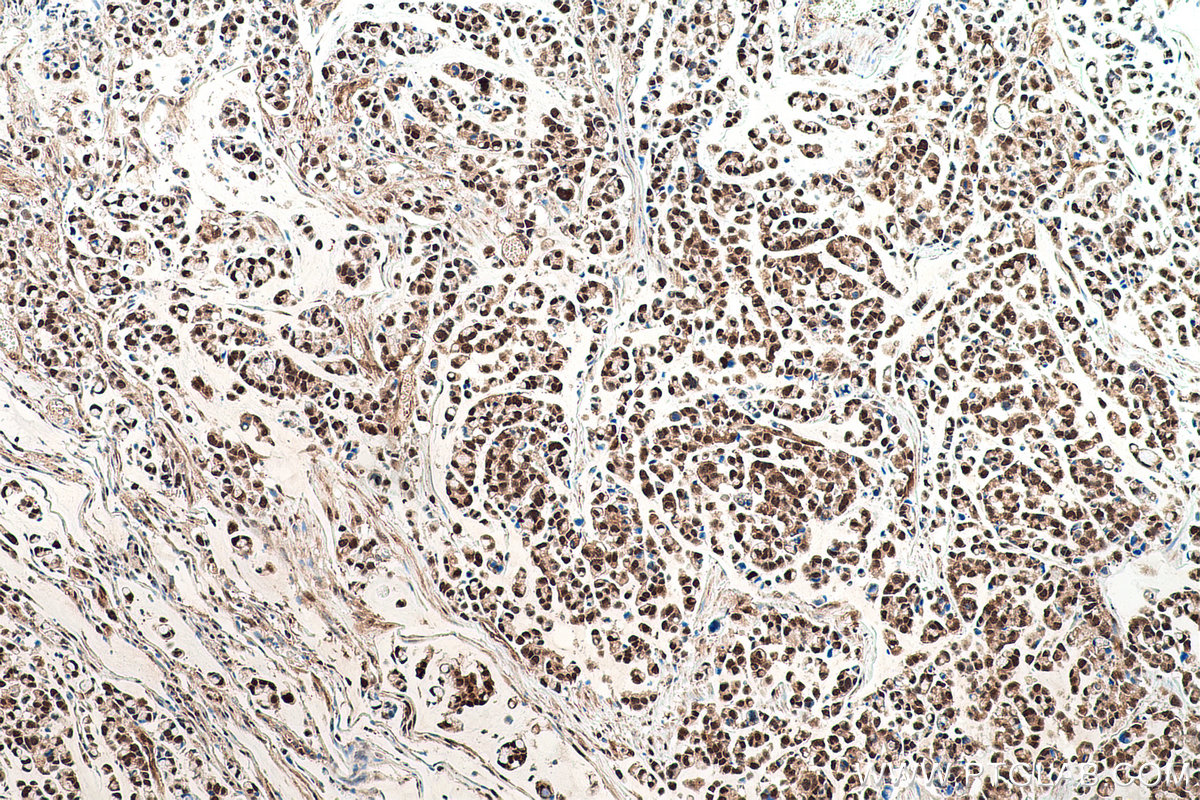 Immunohistochemistry (IHC) staining of human colon cancer tissue using VCP Monoclonal antibody (60316-1-Ig)