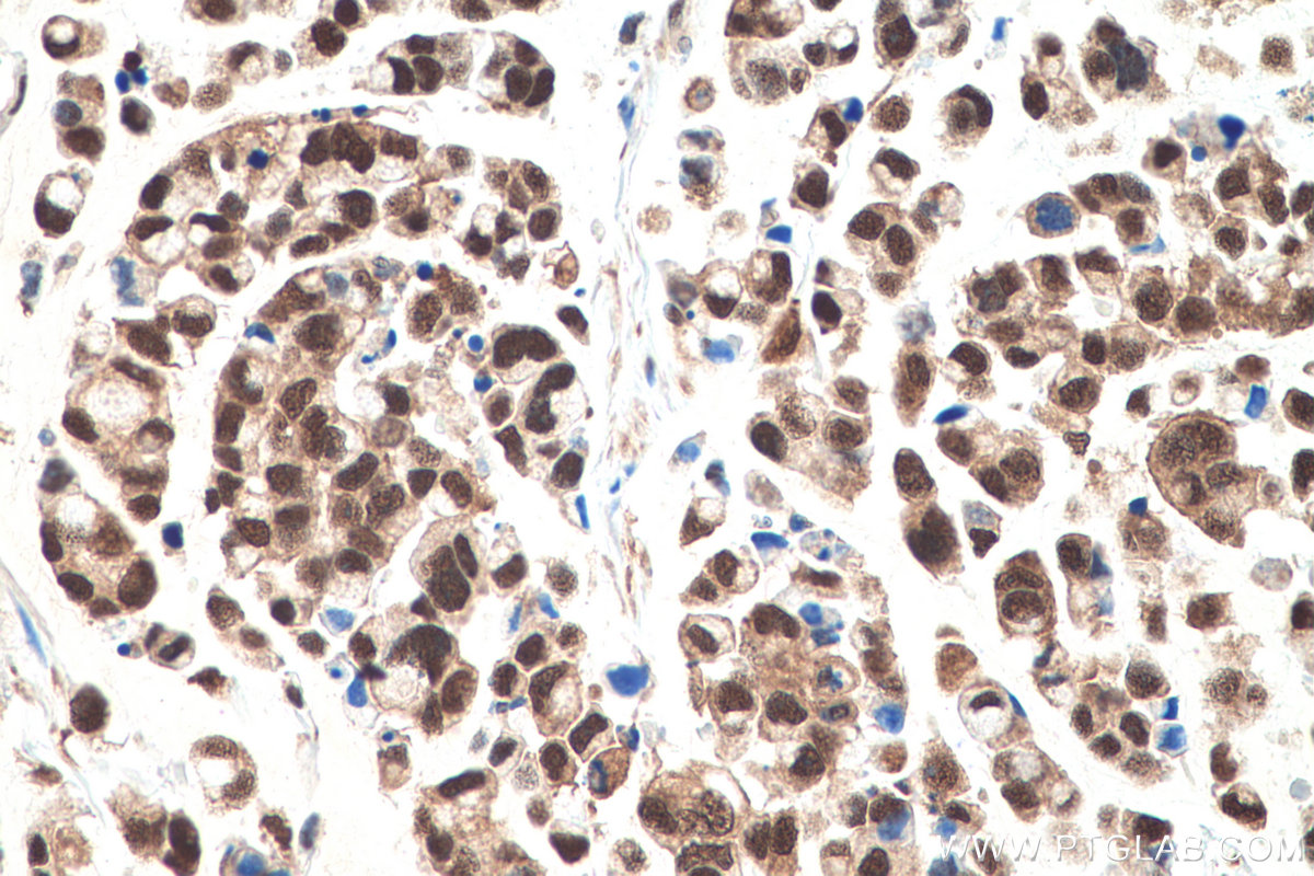 Immunohistochemistry (IHC) staining of human colon cancer tissue using VCP Monoclonal antibody (60316-1-Ig)