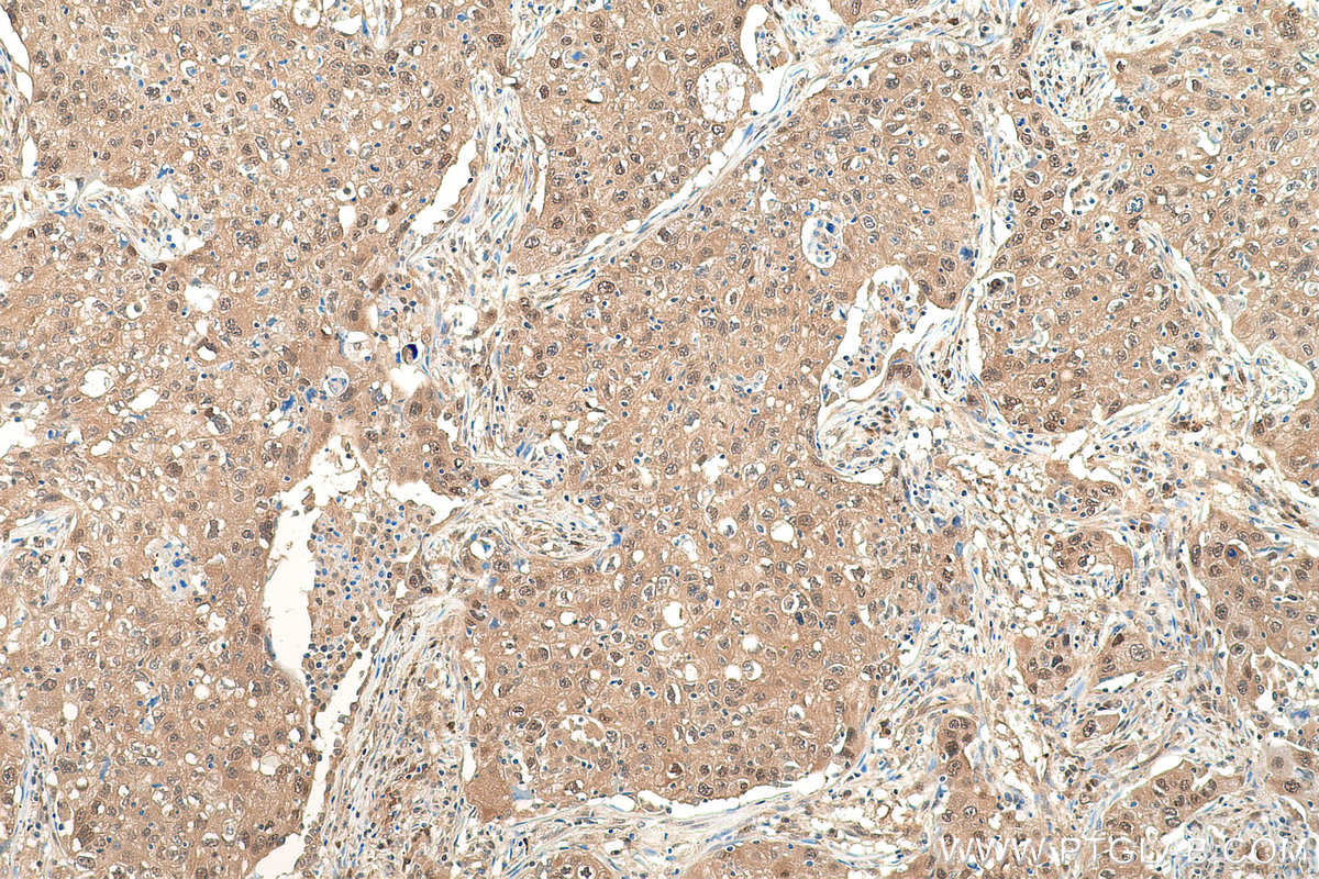 Immunohistochemistry (IHC) staining of human lung cancer tissue using VCP Monoclonal antibody (60316-1-Ig)