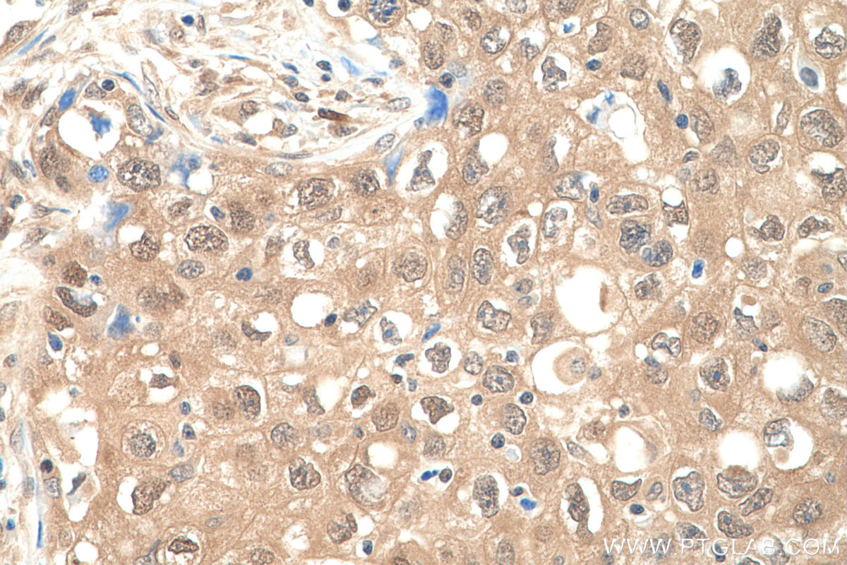 Immunohistochemistry (IHC) staining of human lung cancer tissue using VCP Monoclonal antibody (60316-1-Ig)