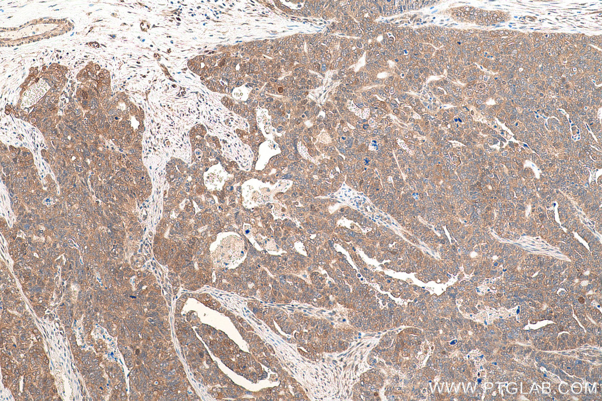 Immunohistochemistry (IHC) staining of human ovary tumor tissue using VCP Monoclonal antibody (60316-1-Ig)