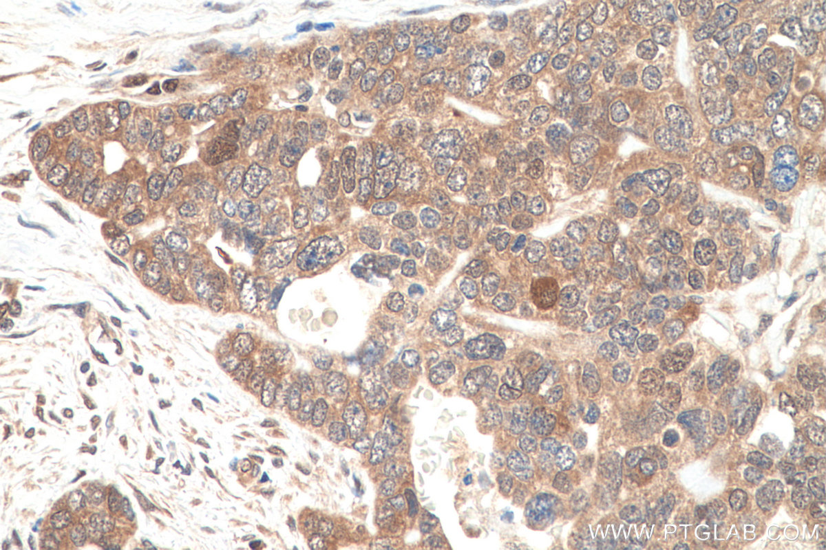 Immunohistochemistry (IHC) staining of human ovary tumor tissue using VCP Monoclonal antibody (60316-1-Ig)