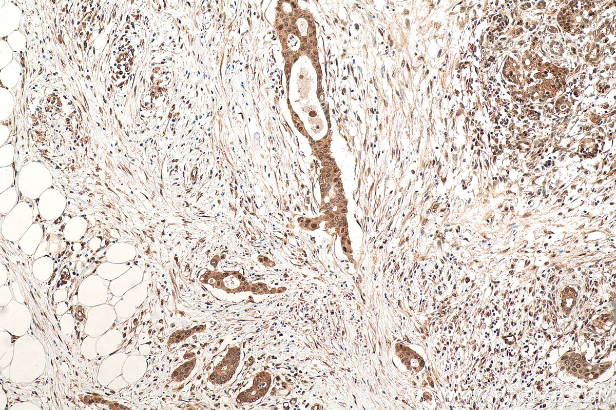 Immunohistochemistry (IHC) staining of human pancreas cancer tissue using VCP Monoclonal antibody (60316-1-Ig)