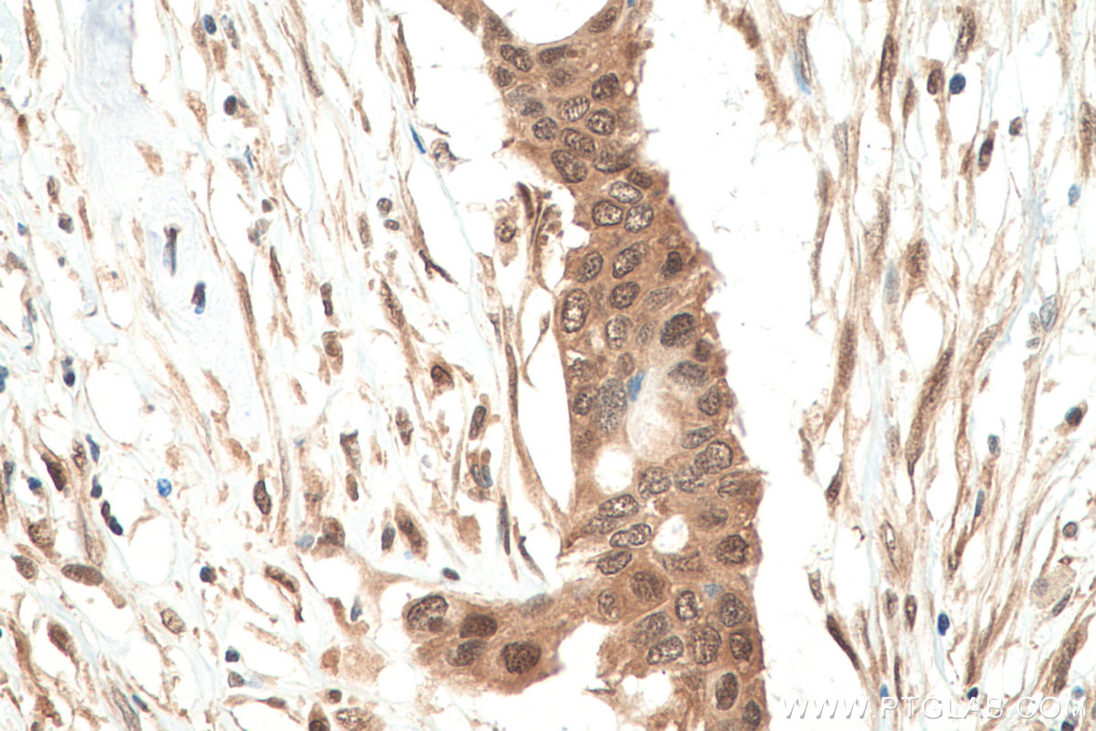 Immunohistochemistry (IHC) staining of human pancreas cancer tissue using VCP Monoclonal antibody (60316-1-Ig)