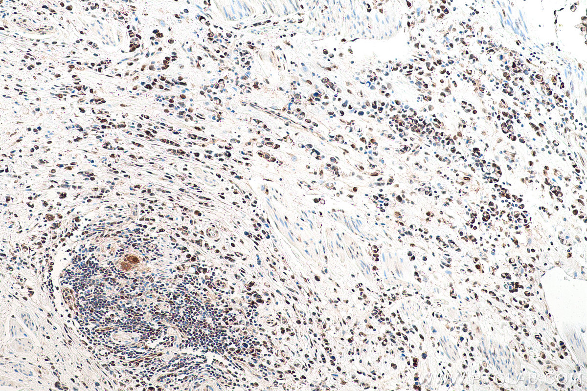 Immunohistochemistry (IHC) staining of human stomach cancer tissue using VCP Monoclonal antibody (60316-1-Ig)