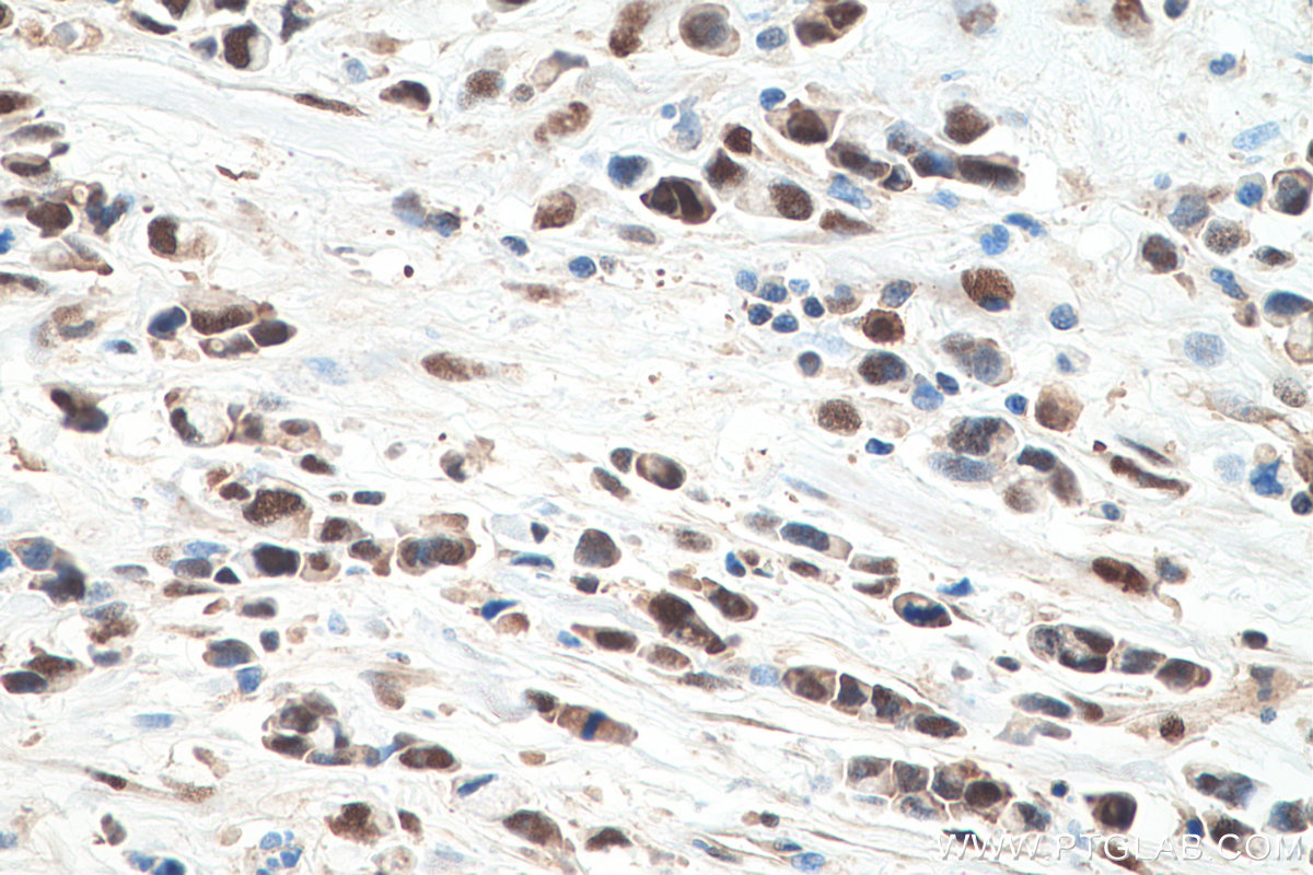 Immunohistochemistry (IHC) staining of human stomach cancer tissue using VCP Monoclonal antibody (60316-1-Ig)