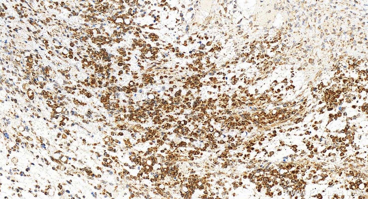 Immunohistochemistry (IHC) staining of human ovary cancer tissue using VDAC3 Recombinant antibody (82666-14-RR)