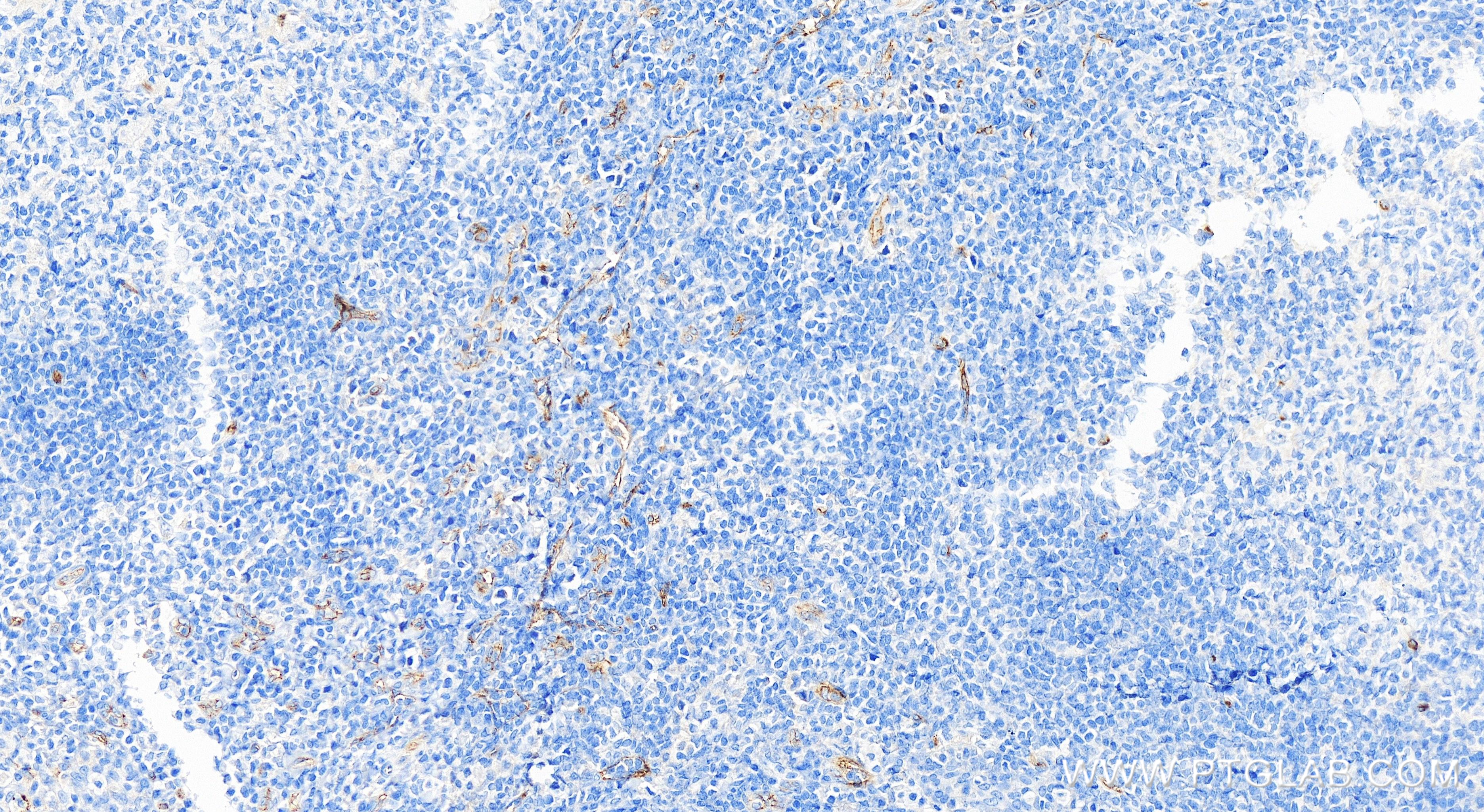 Immunohistochemistry (IHC) staining of human tonsillitis tissue using VEGFR2/KDR Recombinant antibody (83049-4-RR)