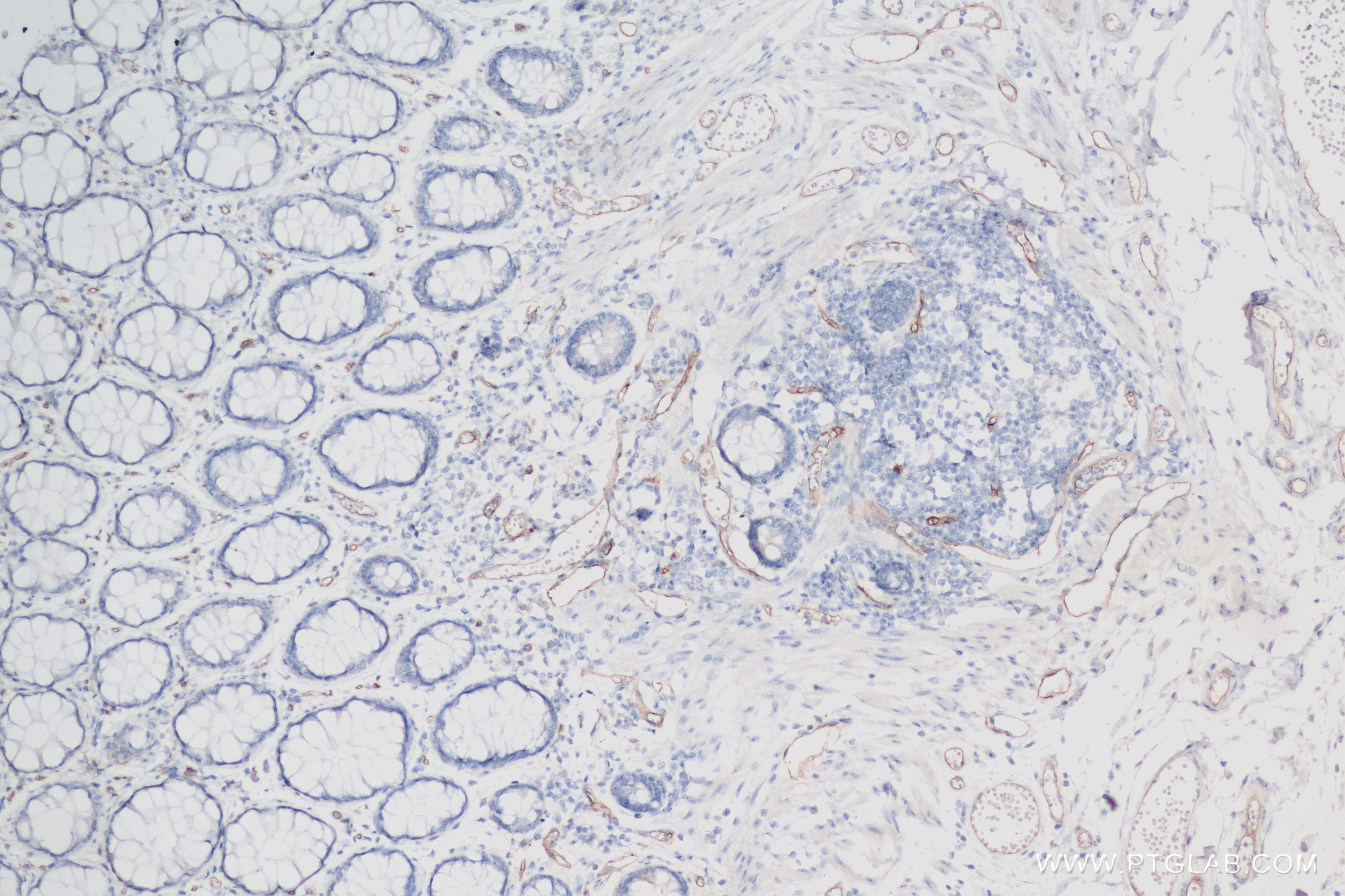 Immunohistochemistry (IHC) staining of human rectal cancer tissue using VEGFR2/KDR Recombinant antibody (83049-4-RR)