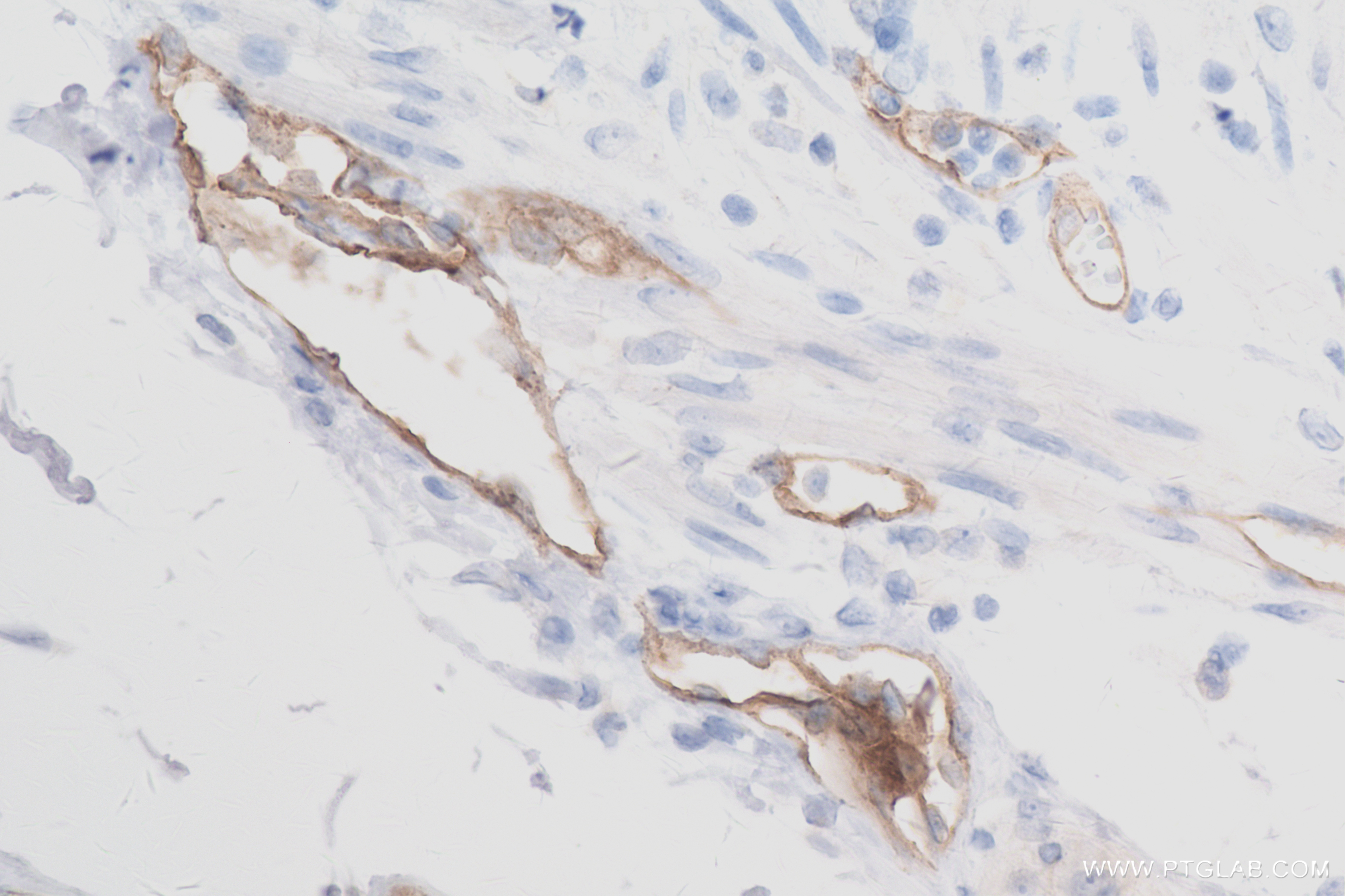 Immunohistochemistry (IHC) staining of human rectal cancer tissue using VEGFR2/KDR Recombinant antibody (83049-4-RR)