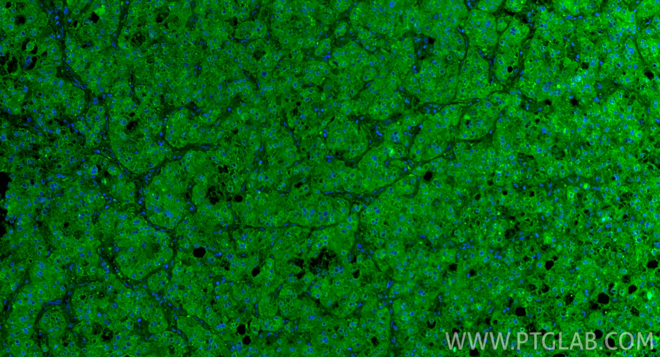 Immunofluorescence (IF) / fluorescent staining of human liver cancer tissue using VEGFA Polyclonal antibody (19003-1-AP)