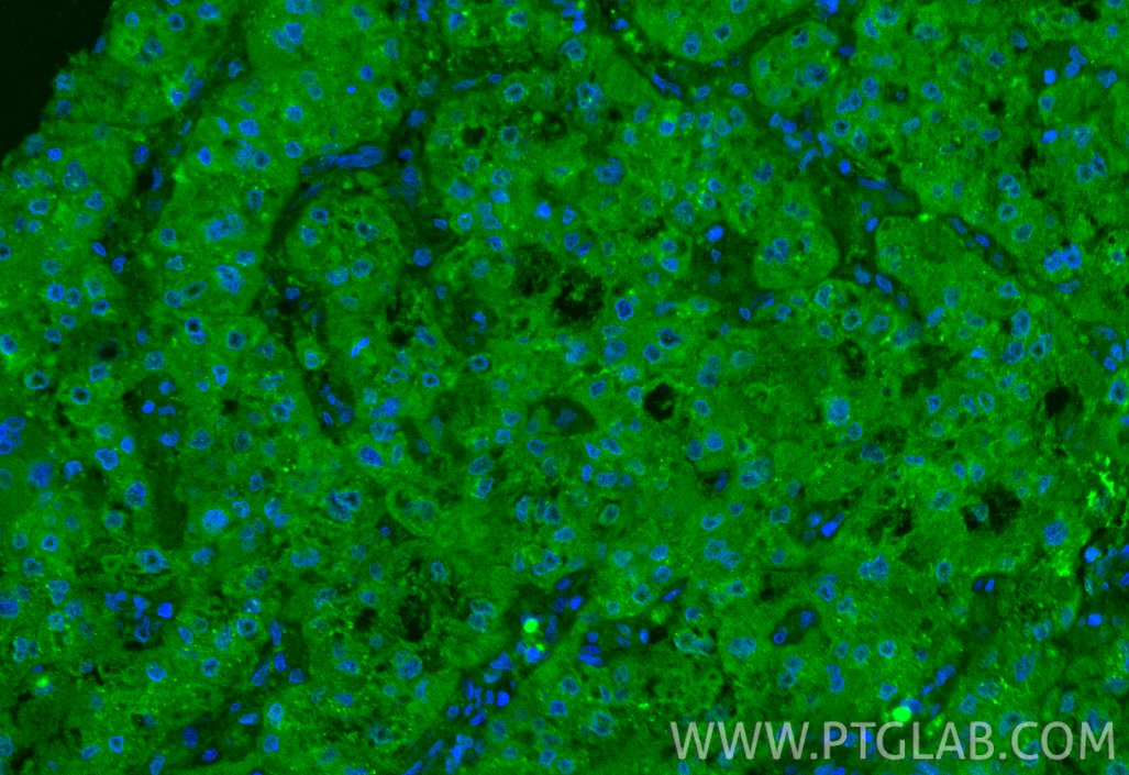 Immunofluorescence (IF) / fluorescent staining of human liver cancer tissue using VEGFA Polyclonal antibody (19003-1-AP)