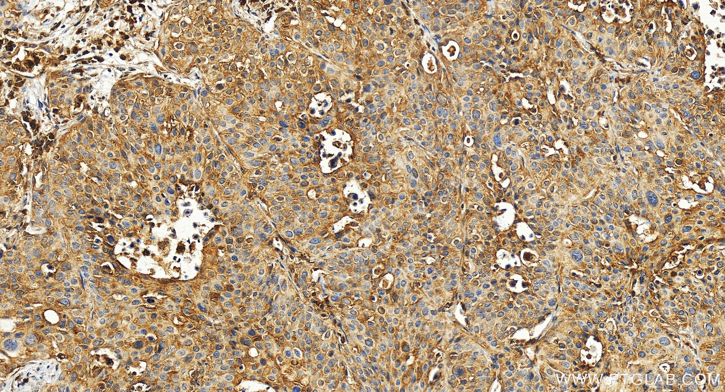 Immunohistochemistry (IHC) staining of human lung cancer tissue using VEGFA Polyclonal antibody (19003-1-AP)