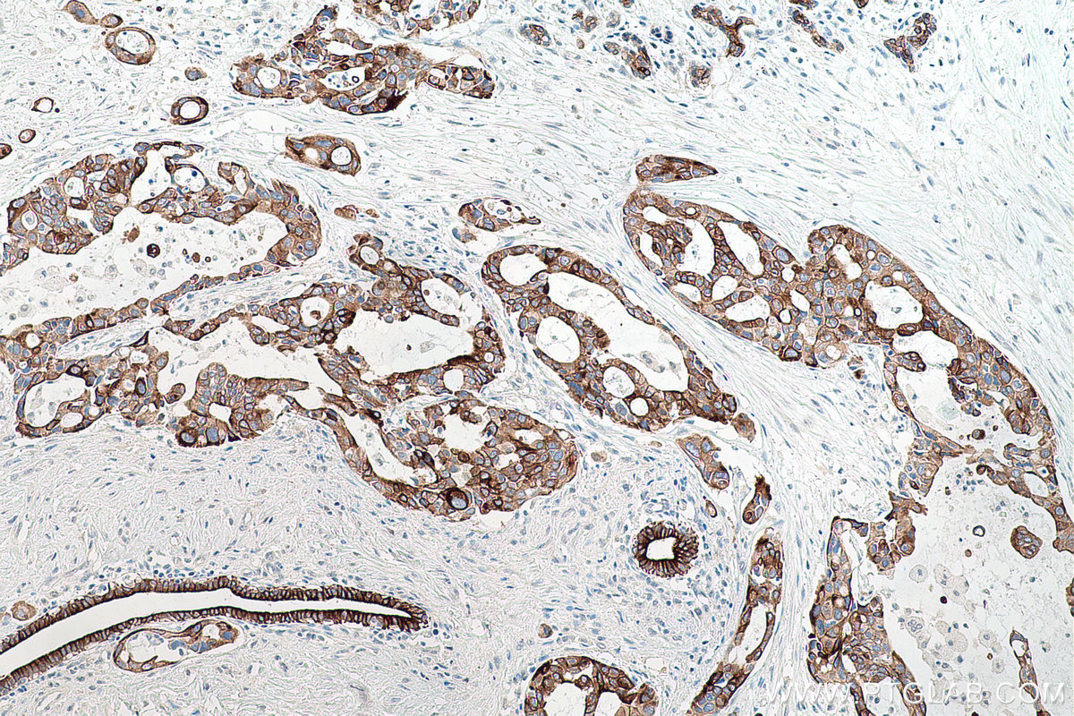 Immunohistochemistry (IHC) staining of human pancreas cancer tissue using VEGFA Monoclonal antibody (66828-1-Ig)