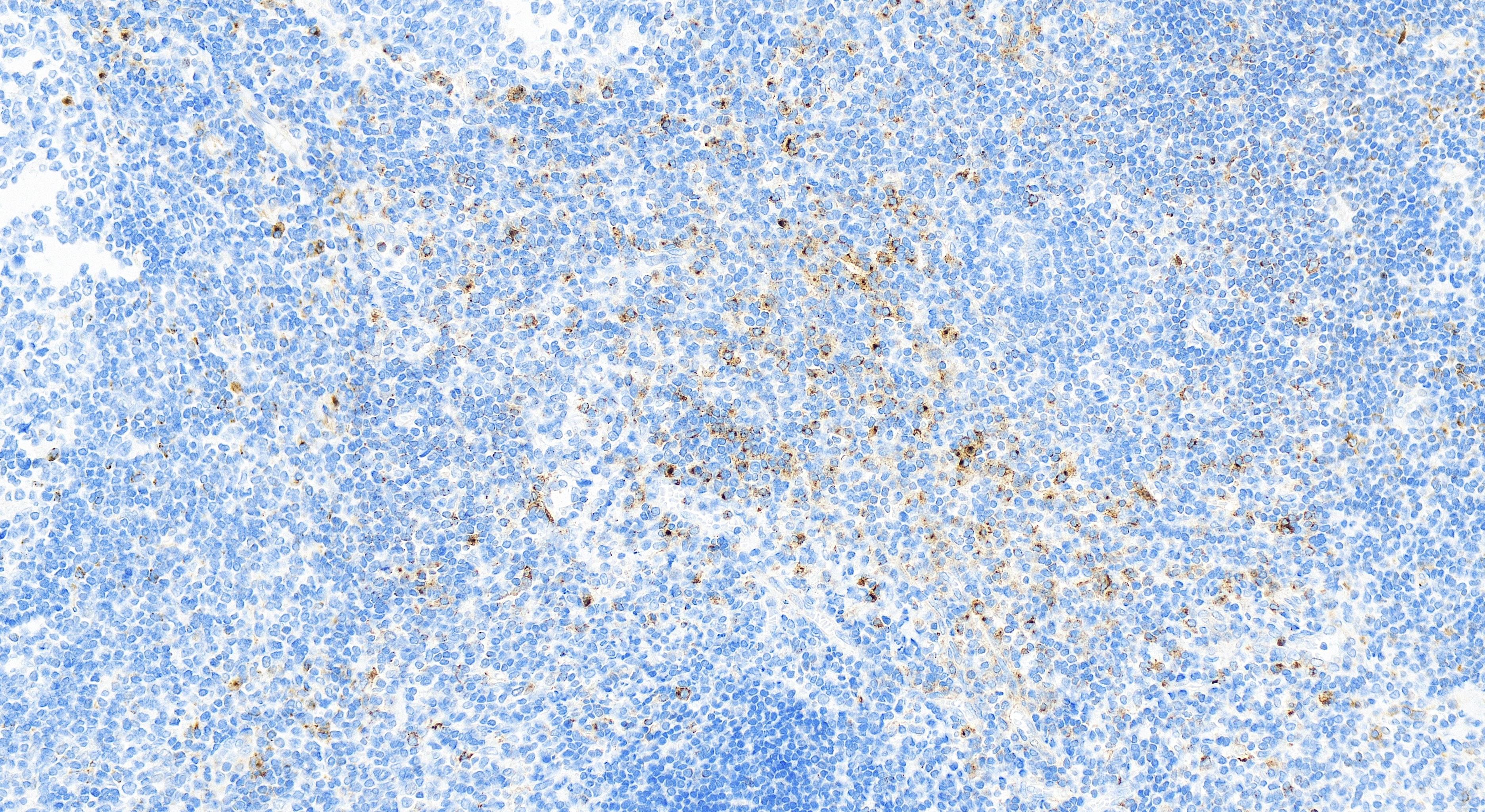 Immunohistochemistry (IHC) staining of human tonsillitis tissue using VISTA Recombinant antibody (83919-4-RR)