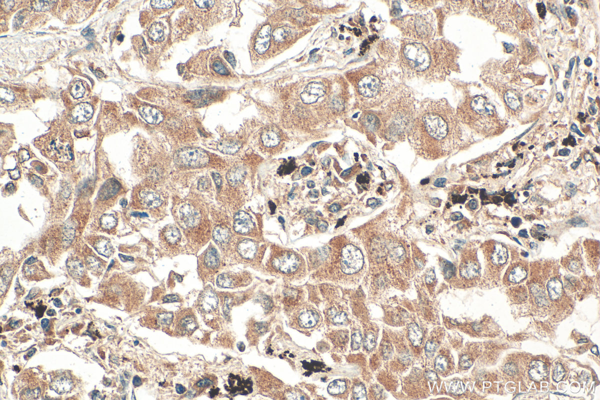 Immunohistochemistry (IHC) staining of human lung cancer tissue using VLDLR Polyclonal antibody (19493-1-AP)