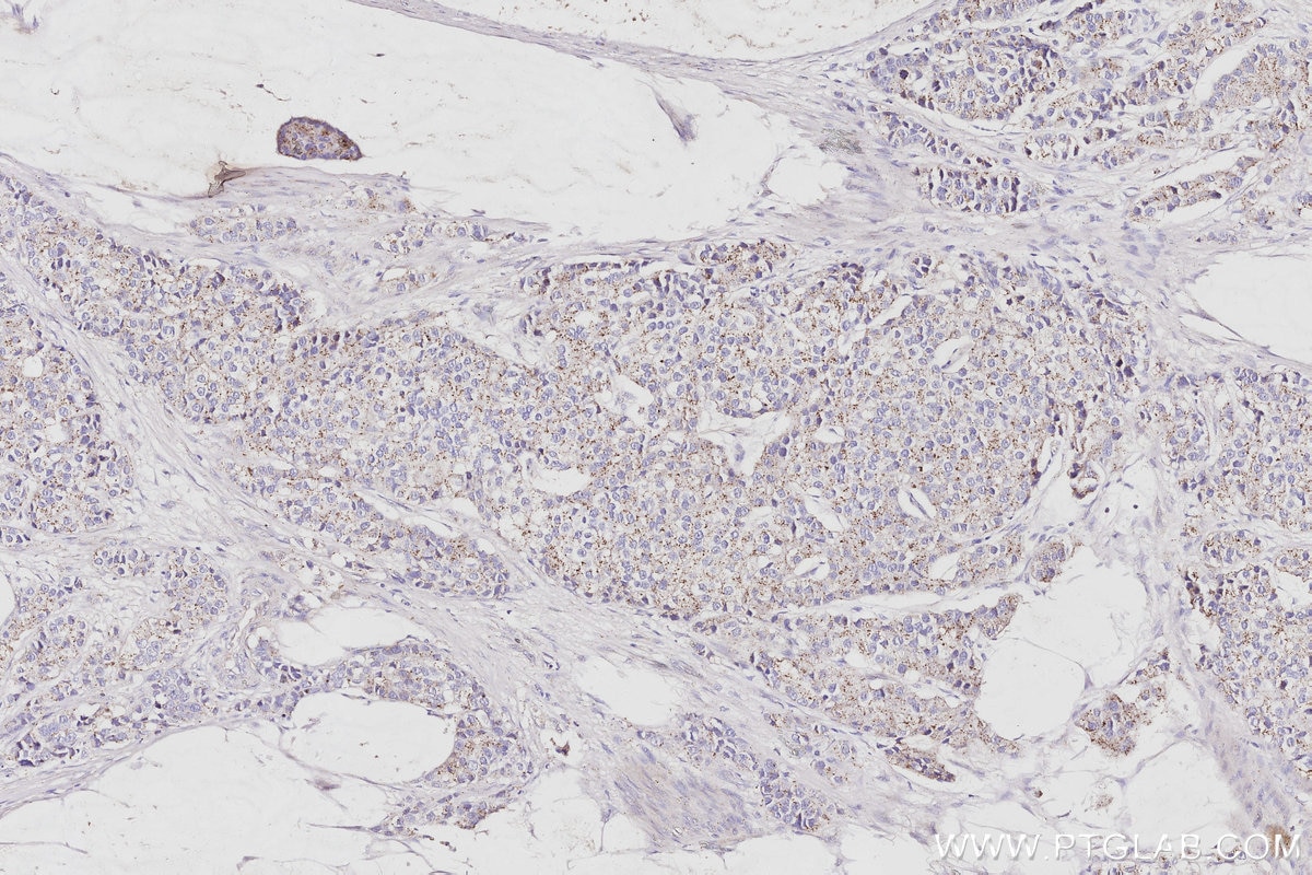 Immunohistochemistry (IHC) staining of human stomach cancer tissue using VPS24 Polyclonal antibody (15472-1-AP)