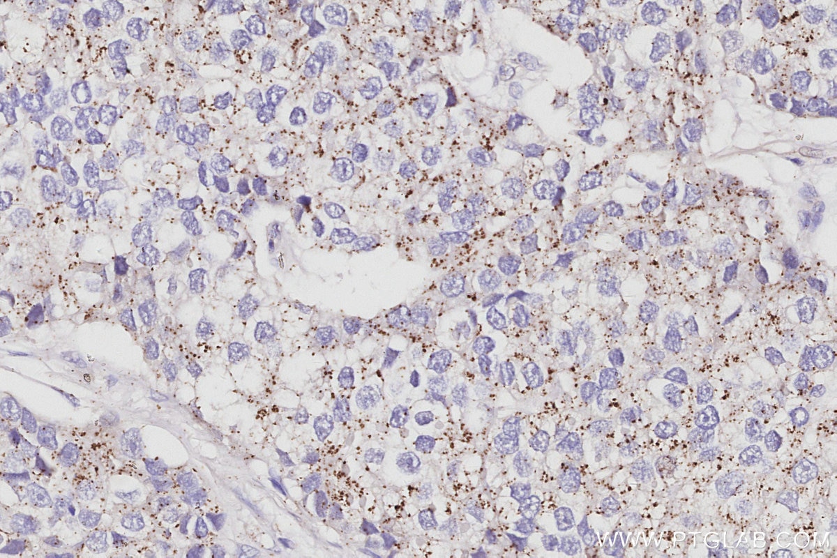 Immunohistochemistry (IHC) staining of human stomach cancer tissue using VPS24 Polyclonal antibody (15472-1-AP)
