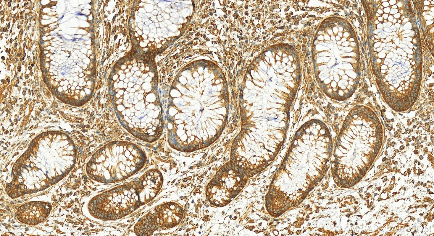 Immunohistochemistry (IHC) staining of human colon cancer tissue using VPS33B Polyclonal antibody (12195-1-AP)