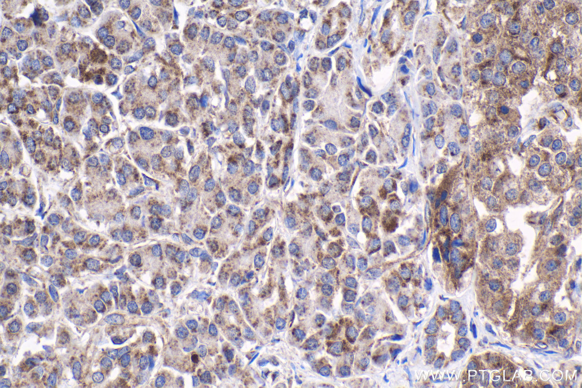 Immunohistochemistry (IHC) staining of human pancreas cancer tissue using VPS36 Polyclonal antibody (14262-1-AP)