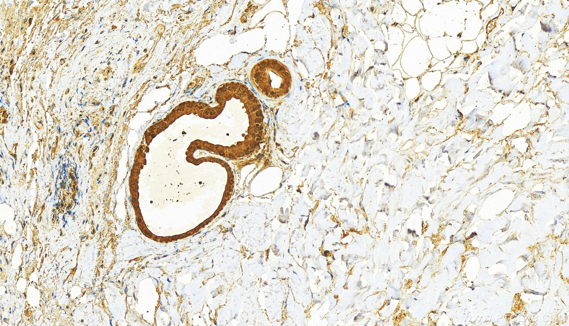 Immunohistochemistry (IHC) staining of human skin cancer tissue using VRK1 Polyclonal antibody (28018-1-AP)