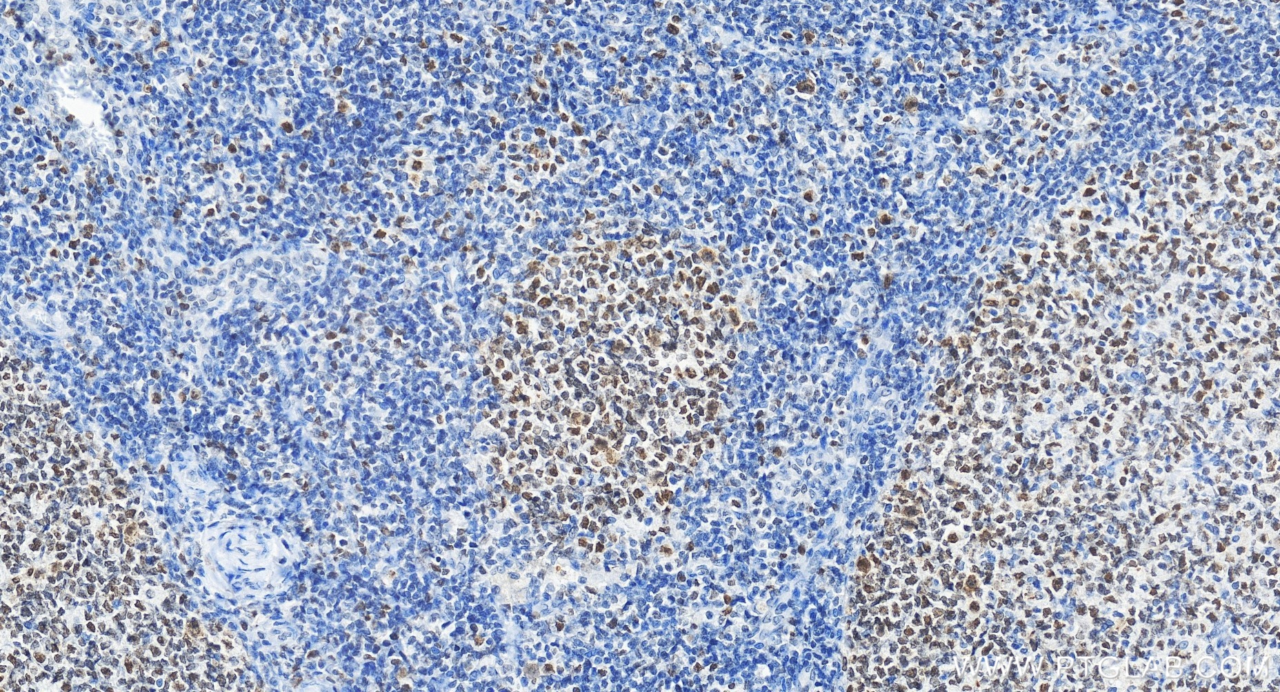 Immunohistochemistry (IHC) staining of human tonsillitis tissue using VRK1 Recombinant monoclonal antibody (85598-2-RR)