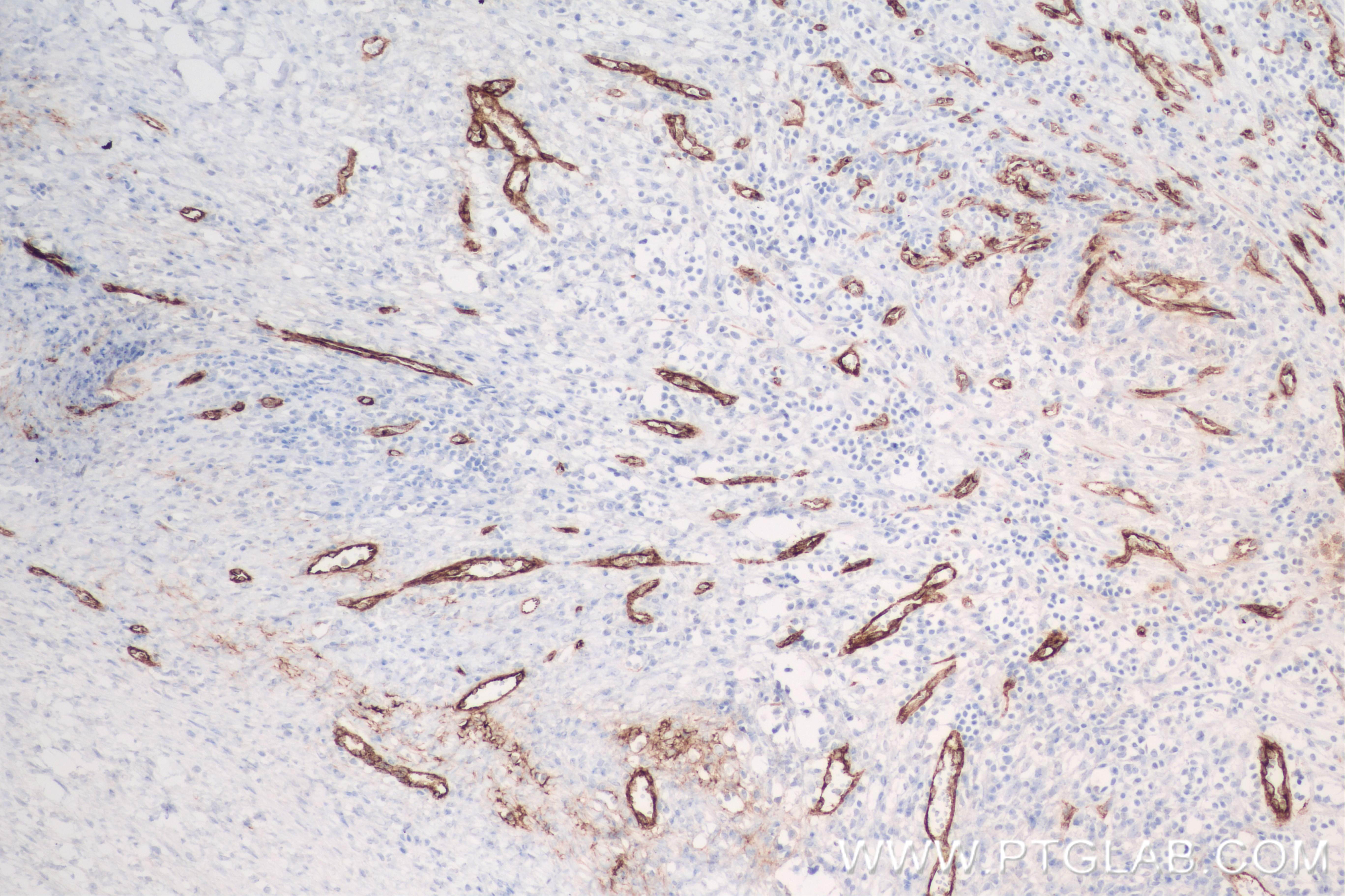 Immunohistochemistry (IHC) staining of human ovary cancer tissue using VWF Recombinant antibody (83854-2-RR)