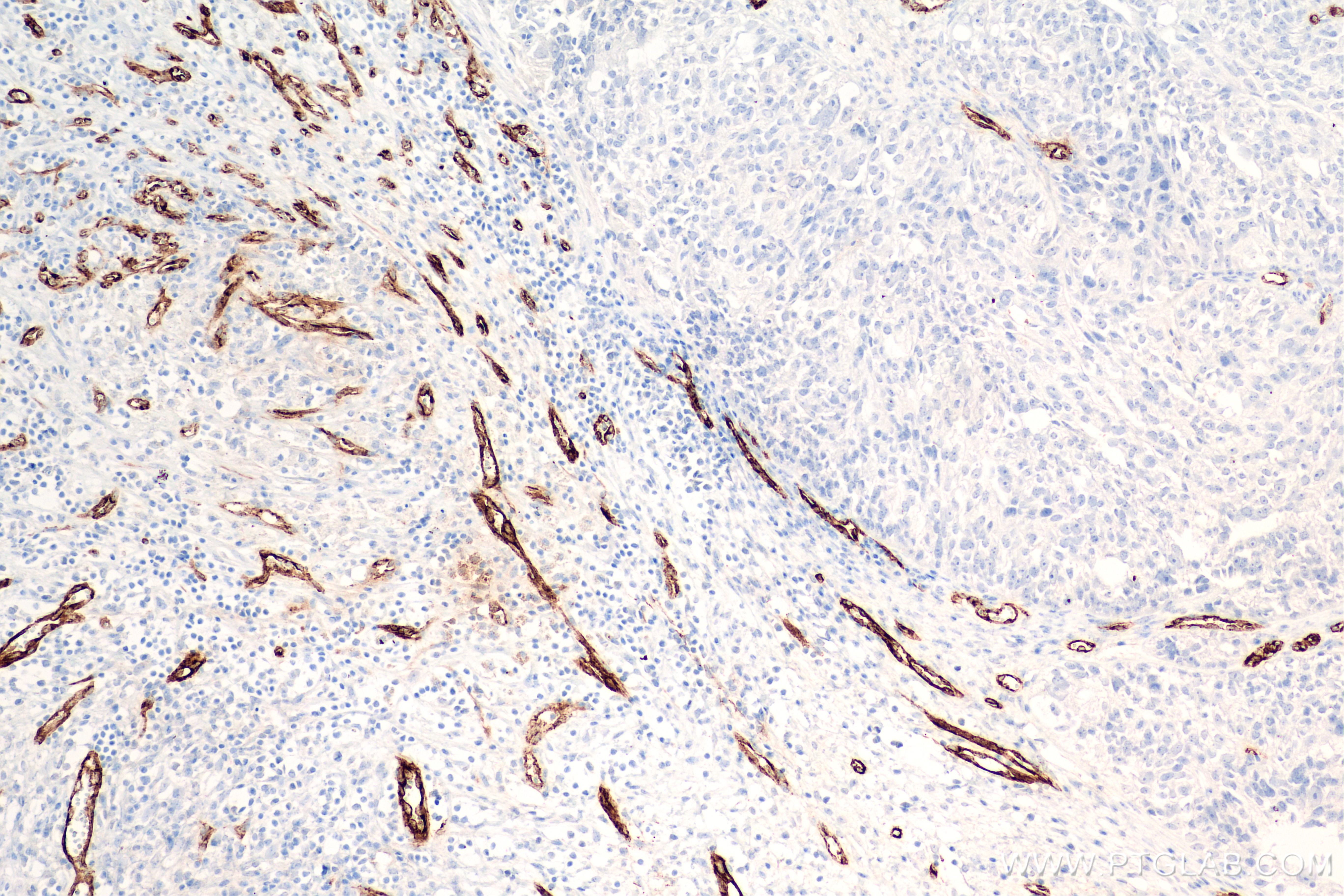 Immunohistochemistry (IHC) staining of human ovary cancer tissue using VWF Recombinant antibody (83854-2-RR)