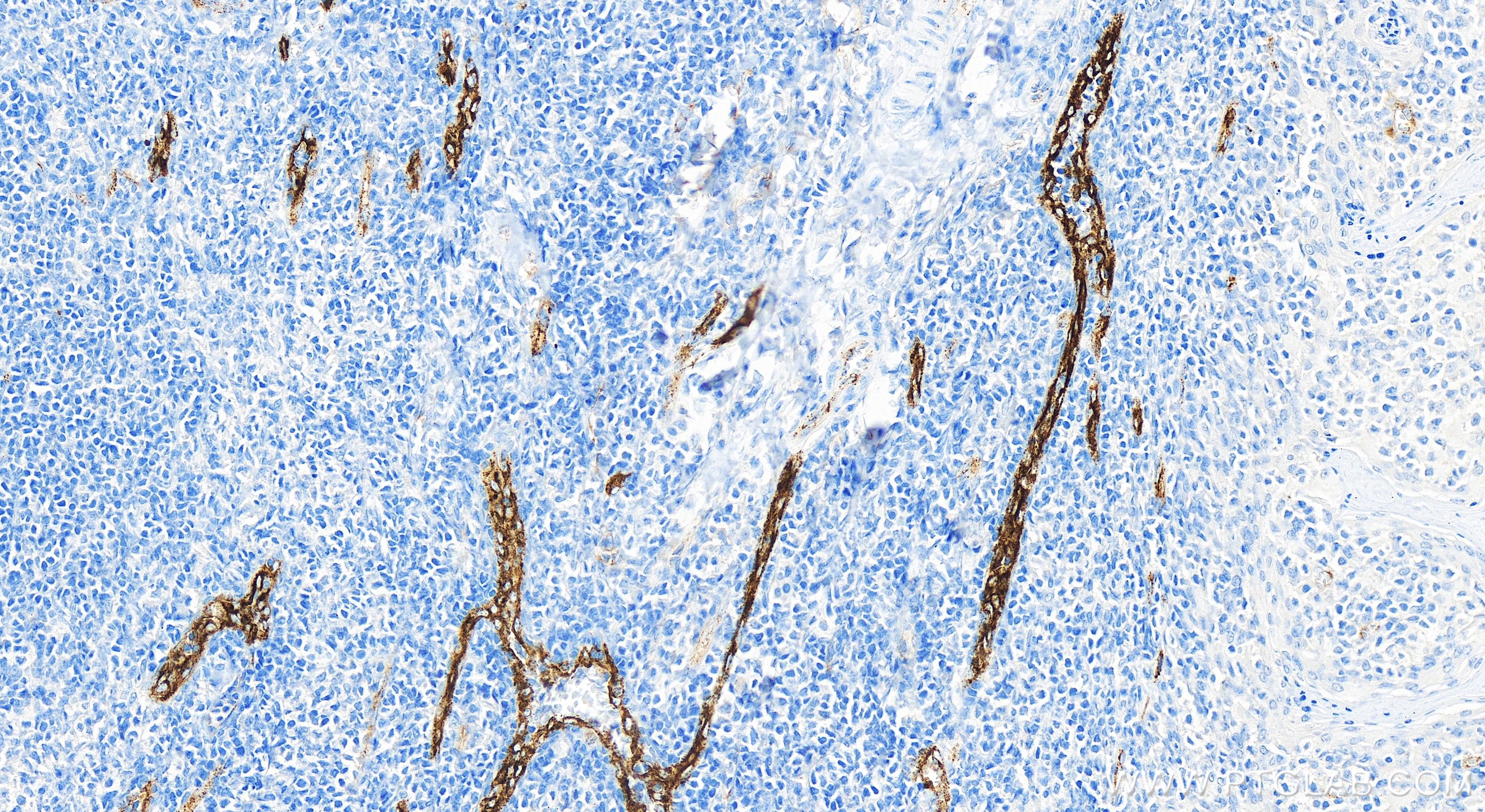 Immunohistochemistry (IHC) staining of human tonsillitis tissue using VWF Recombinant antibody (83854-2-RR)