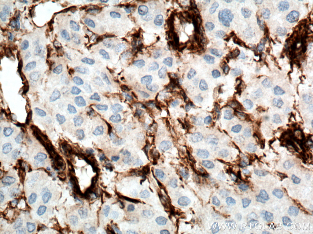 Immunohistochemistry (IHC) staining of human liver cancer tissue using Vimentin Monoclonal antibody (60330-1-Ig)