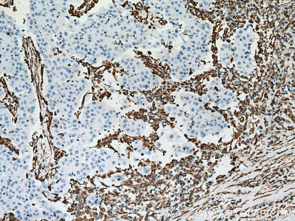 Immunohistochemistry (IHC) staining of human breast cancer tissue using Vimentin Monoclonal antibody (60330-1-Ig)