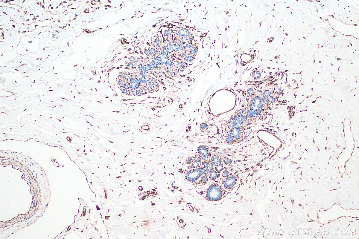 Immunohistochemistry (IHC) staining of human breast cancer tissue using Vimentin Monoclonal antibody (60330-1-Ig)