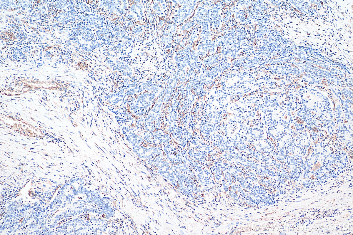 Immunohistochemistry (IHC) staining of human colon cancer tissue using Vimentin Monoclonal antibody (60330-1-Ig)