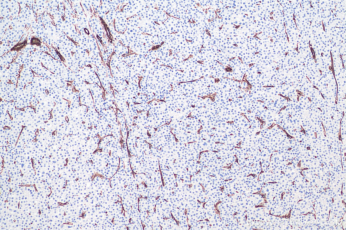 Immunohistochemistry (IHC) staining of human liver cancer tissue using Vimentin Monoclonal antibody (60330-1-Ig)